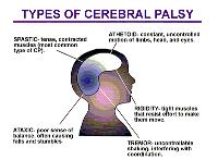 Best Stem cell therapy for Cerebral Palsy in India image 1